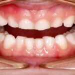 Tooth Grinding Can Be Linked To Sleep Deprivation